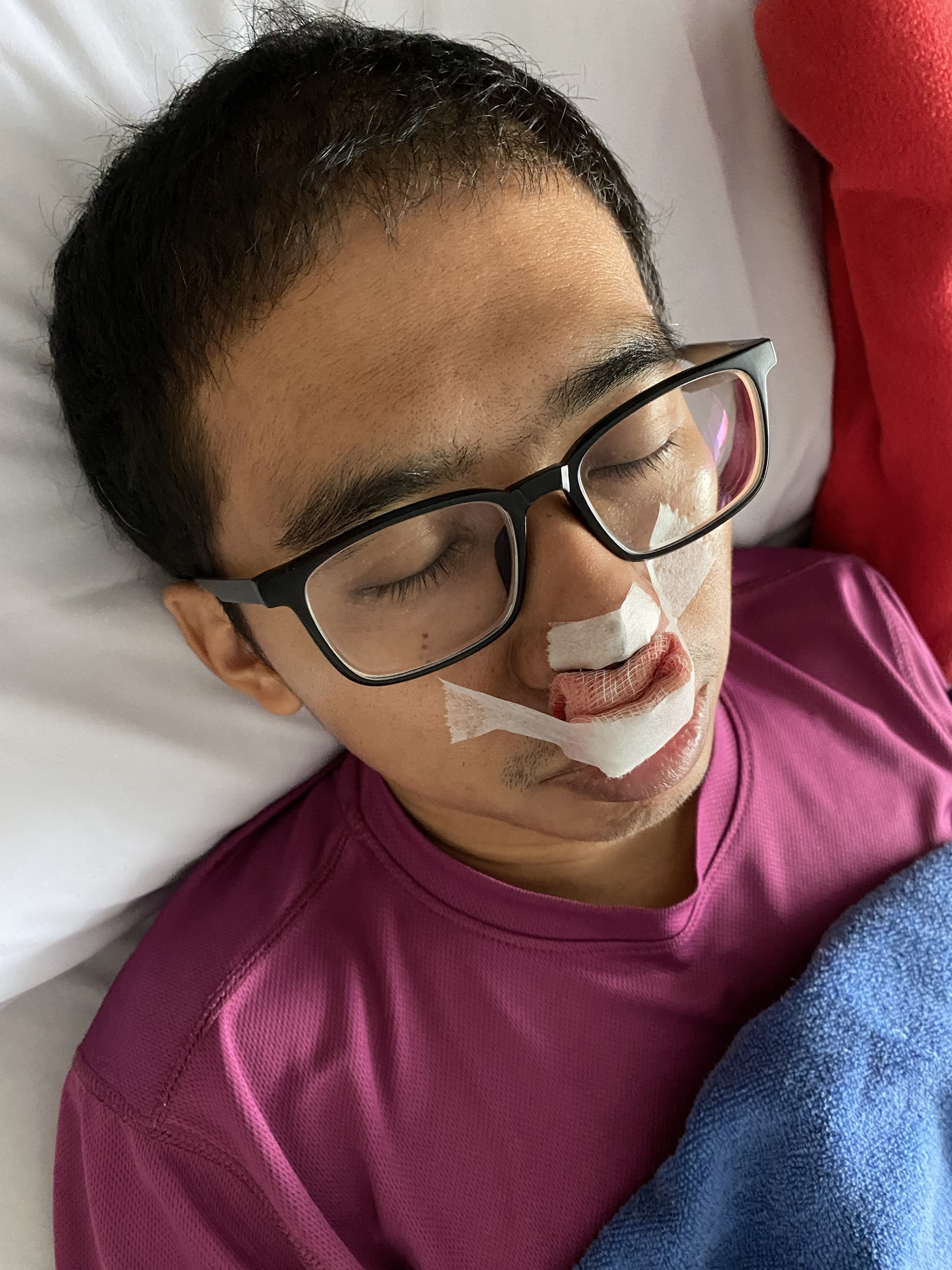 Pembedahan Nasal Polyp aku